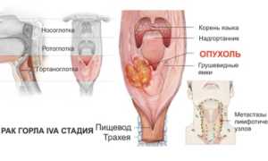 Лечение рака горла, какие методы применяют и какой из них наиболее эффективный?