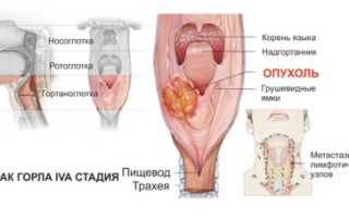 Лечение рака горла, какие методы применяют и какой из них наиболее эффективный?