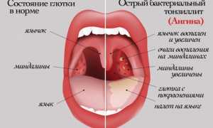 Заразна ли ангина для окружающих?