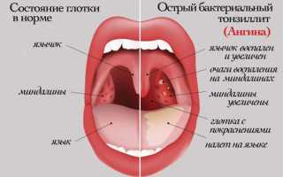 Заразна ли ангина для окружающих?