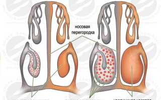 Вазомоторный риносинусит