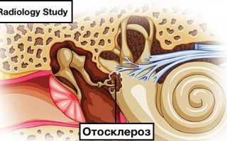Отосклероз (Отоспонгиоз): симптомы и лечение