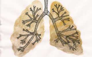 Чем лечить бронхит у беременных