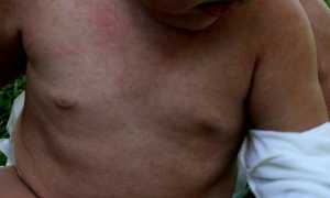 Розеола детская