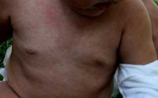 Розеола детская