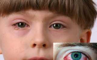 Реактивный артрит у детей – причины, симптомы, диагностика и лечение