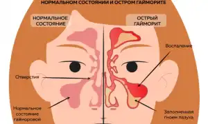 Гайморит при беременности