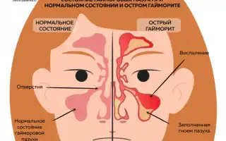 Гайморит при беременности