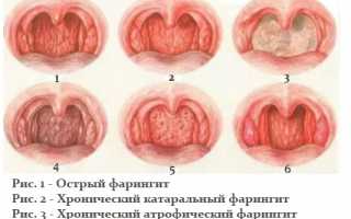 Катаральный фарингит: причины, симптомы и методы лечения
