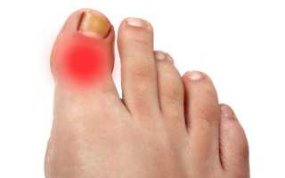 Воспаление сустава большого пальца ноги: симптомы, способы терапии