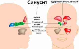Катаральный синусит