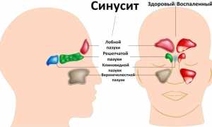 Классификация синуситов: виды, формы и типы синуситов