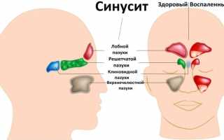 Классификация синуситов: виды, формы и типы синуситов