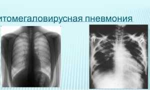 Цитомегаловирус и пневмонии