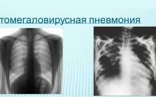 Цитомегаловирус и пневмонии