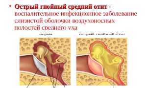 Булькает в ухе, какие могут быть причины, и как избавляться от хлюпанья в ушах