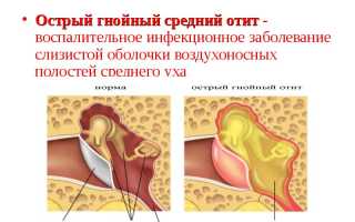 Булькает в ухе, какие могут быть причины, и как избавляться от хлюпанья в ушах