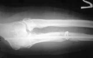 Ложный сустав после переломов и повреждений