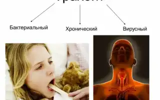 Хронический трахеит — лечение у взрослых и детей
