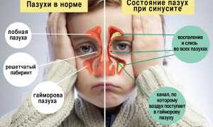 Гайморит у детей
