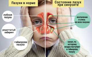 Гайморит у детей