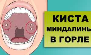 Киста миндалины — первые симптомы и лечение
