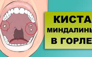 Киста миндалины — первые симптомы и лечение