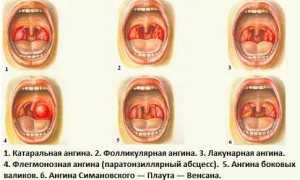 Флегмонозная ангина – особенности заболевания, симптомы, методы лечения
