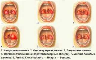 Флегмонозная ангина – особенности заболевания, симптомы, методы лечения