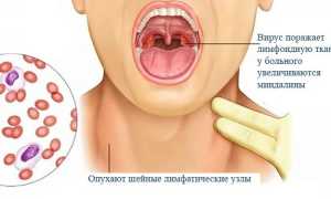 Вирус Эпштейна-Барра