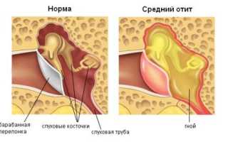 Буллезный (вирусный) отит: симптомы, лечение
