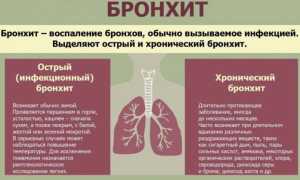Что такое трахеобронхит, как развивается острый и хронический трахеобронхит, симптомы и лечение у детей и взрослых