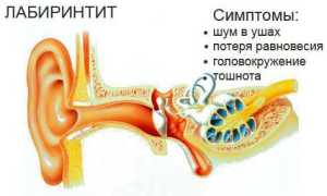 Лабиринтит или внутренний отит