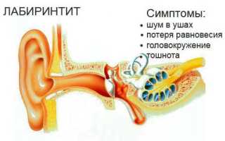 Лабиринтит или внутренний отит