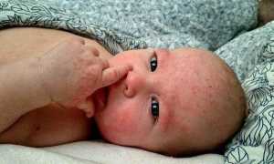 Диатез у грудничка: изучаем причины аллергической реакции и правильные методы лечения