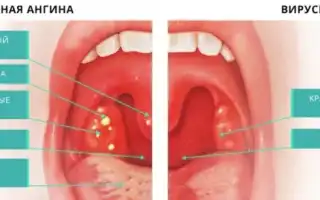 Бактериальная ангина, как ее отличить от вирусной, симптомы и лечение бактериальной ангины у детей и взрослых