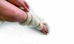 Варикоз при беременности: делаем профилактику и лечим в домашних условиях