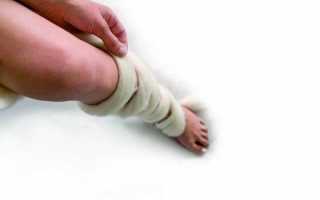 Варикоз при беременности: делаем профилактику и лечим в домашних условиях