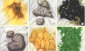 Проблемы со стулом у новорожденного