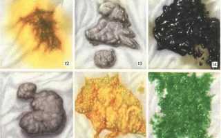 Проблемы со стулом у новорожденного