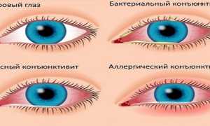 Конъюнктивит из-за герпеса