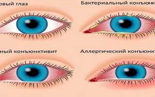Конъюнктивит из-за герпеса