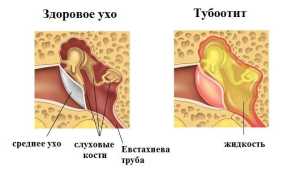 Тубоотит у взрослых и детей: причины, симптомы, лечение