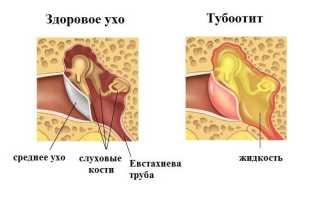 Тубоотит у взрослых и детей: причины, симптомы, лечение