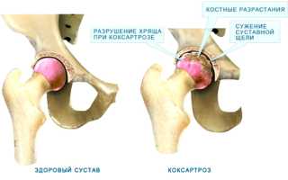 Коксартроз тазобедренного сустава: степени тяжести, симптомы и лечение
