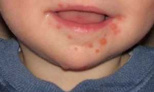 Вирус коксаки у детей: симптомы и лечение, фото, Комаровский