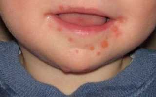 Вирус коксаки у детей: симптомы и лечение, фото, Комаровский