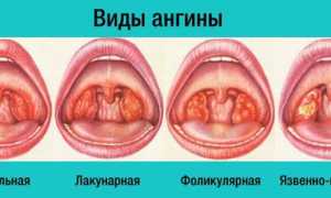 Лакунарная ангина у детей