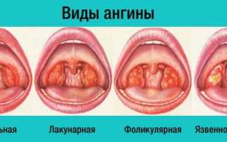 Лакунарная ангина у детей