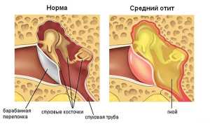 Хронический отит у взрослых и детей